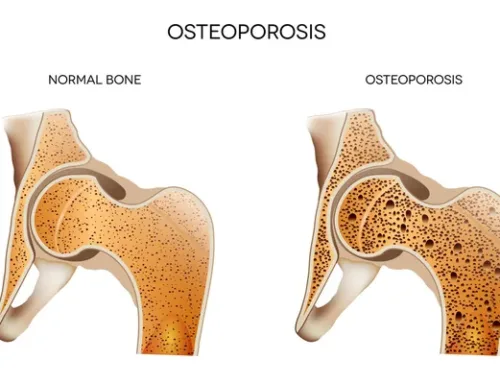 Ejercicio físico y osteoporosis