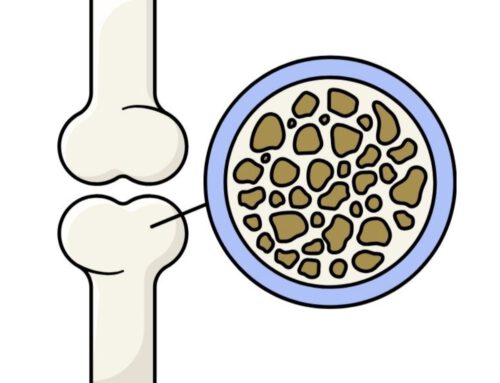 Vencer la fragilidad: El papel del ejercicio físico en la osteoporosis y el bienestar emocional